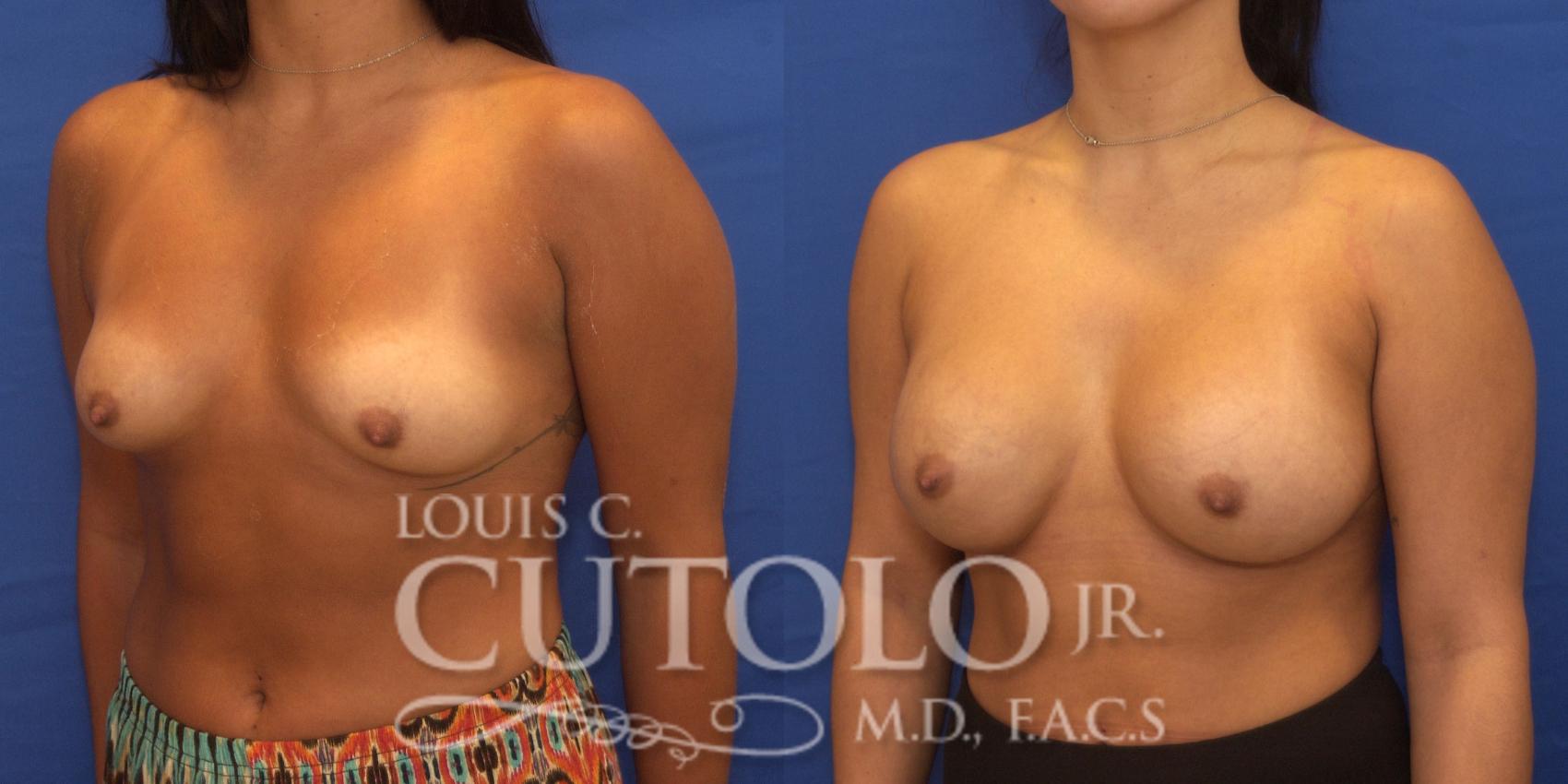 Before & After Breast Augmentation Case 228 View #2 View in Brooklyn, Staten Island, Queens, NY