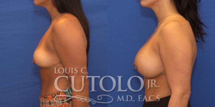 Before & After Breast Augmentation Case 228 View #3 View in Brooklyn, Staten Island, Queens, NY