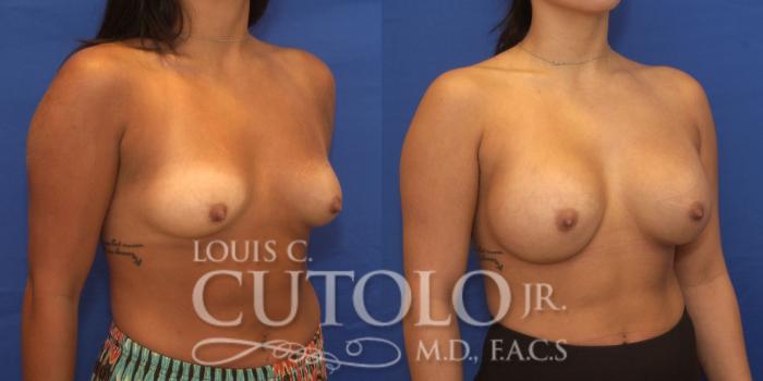 Before & After Breast Augmentation Case 228 View #4 View in Brooklyn, Staten Island, Queens, NY