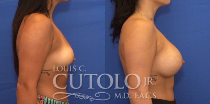 Before & After Breast Augmentation Case 228 View #5 View in Brooklyn, Staten Island, Queens, NY