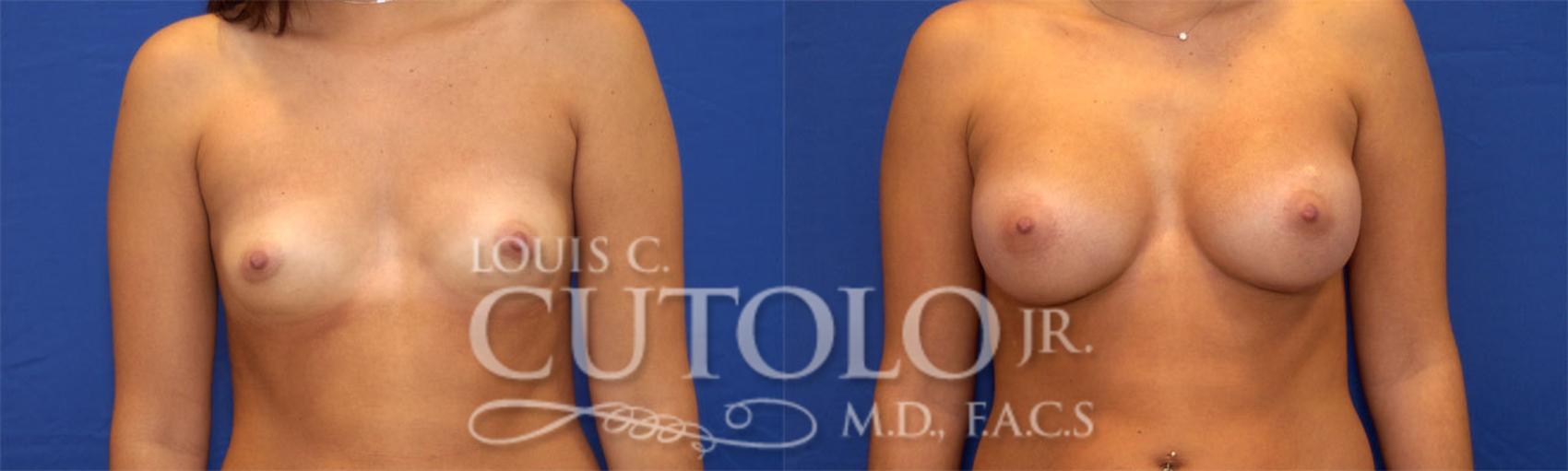 Before & After Breast Augmentation Case 23 View #1 View in Brooklyn, Staten Island, Queens, NY