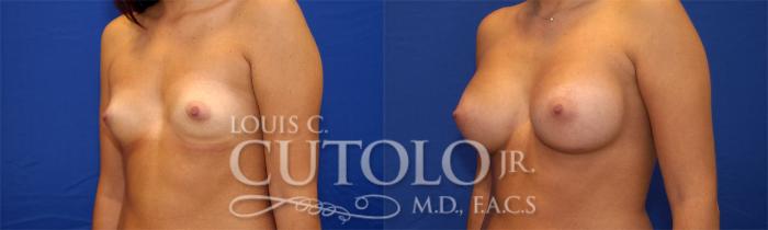 Before & After Breast Augmentation Case 23 View #2 View in Brooklyn, Staten Island, Queens, NY