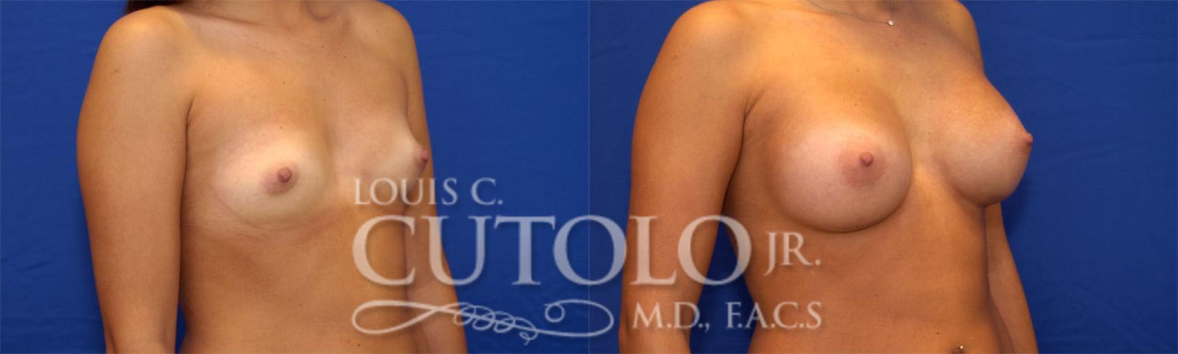 Before & After Breast Augmentation Case 23 View #3 View in Brooklyn, Staten Island, Queens, NY