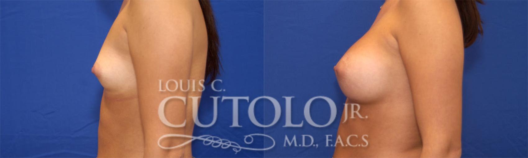Before & After Breast Augmentation Case 23 View #4 View in Brooklyn, Staten Island, Queens, NY