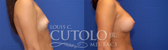 Before & After Breast Augmentation Case 23 View #5 View in Brooklyn, Staten Island, Queens, NY