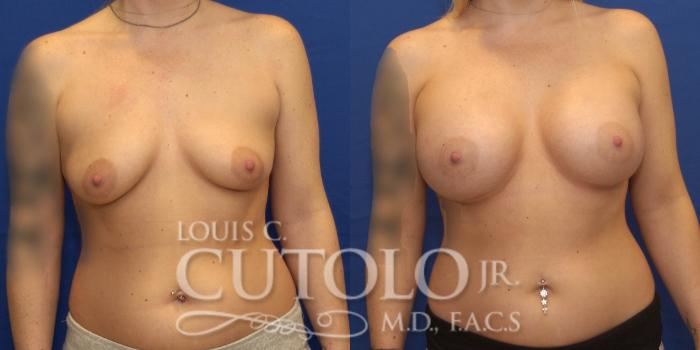 Before & After Breast Augmentation Case 230 View #1 View in Brooklyn, Staten Island, Queens, NY