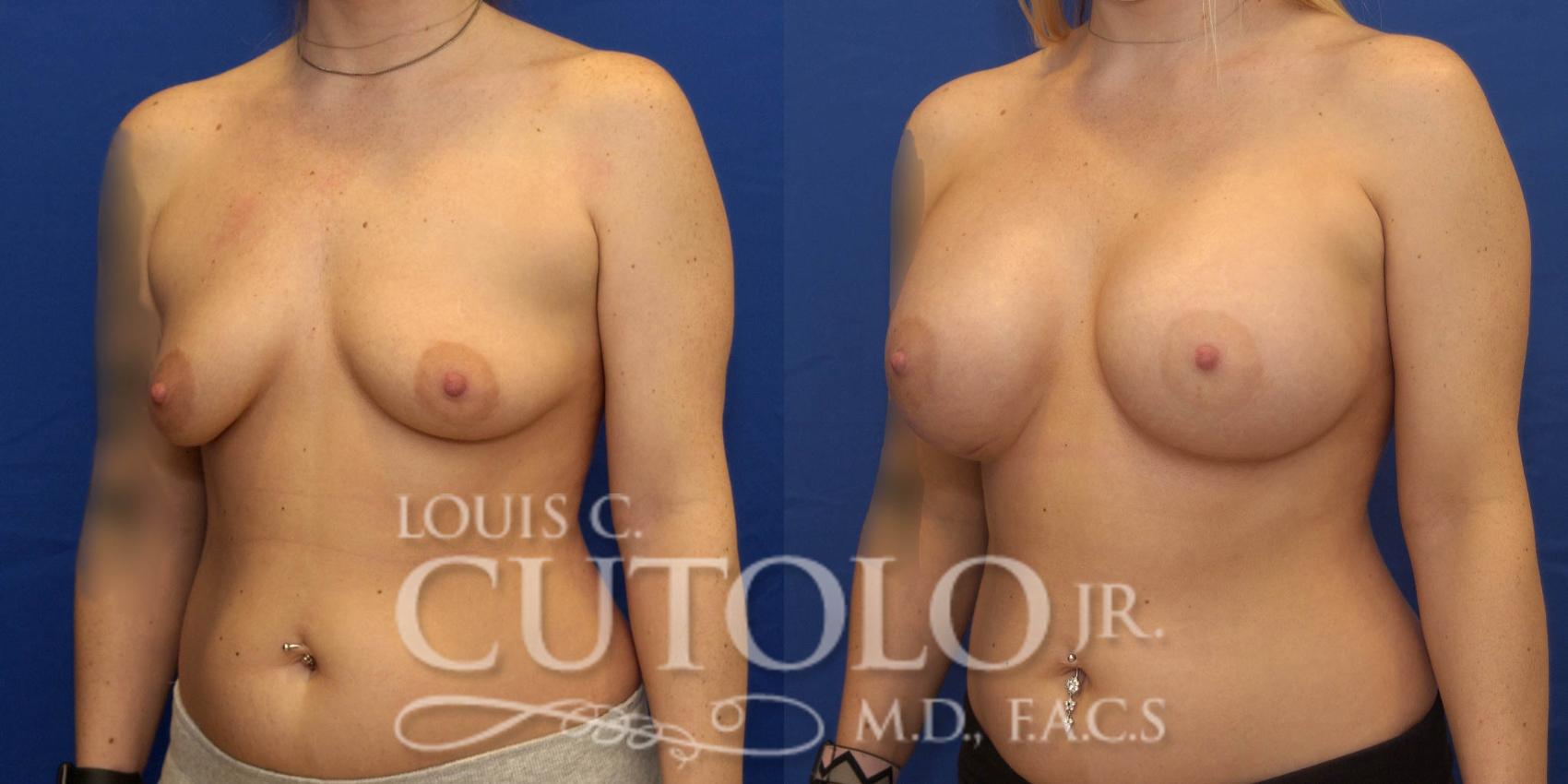 Before & After Breast Augmentation Case 230 View #2 View in Brooklyn, Staten Island, Queens, NY