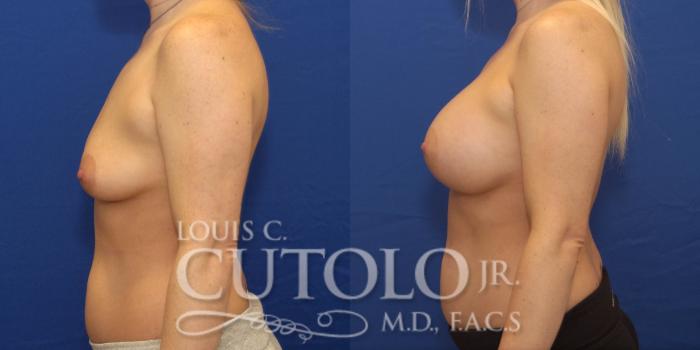 Before & After Breast Augmentation Case 230 View #3 View in Brooklyn, Staten Island, Queens, NY