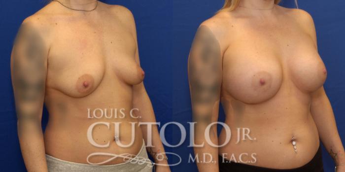 Before & After Breast Augmentation Case 230 View #4 View in Brooklyn, Staten Island, Queens, NY