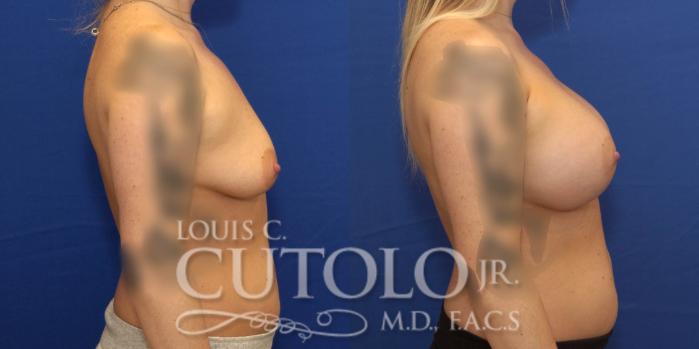 Before & After Breast Augmentation Case 230 View #5 View in Brooklyn, Staten Island, Queens, NY