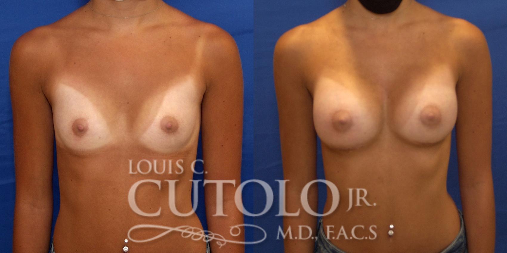 Before & After Breast Augmentation Case 231 Front View in Brooklyn, Staten Island, Queens, NY