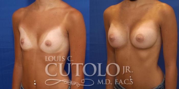 Before & After Breast Augmentation Case 231 Left Oblique View in Brooklyn, Staten Island, Queens, NY