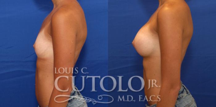Before & After Breast Augmentation Case 231 Left Side View in Brooklyn, Staten Island, Queens, NY