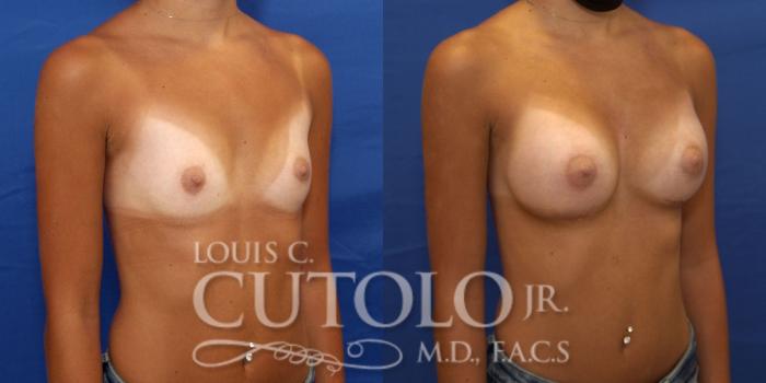 Before & After Breast Augmentation Case 231 Right Oblique View in Brooklyn, Staten Island, Queens, NY
