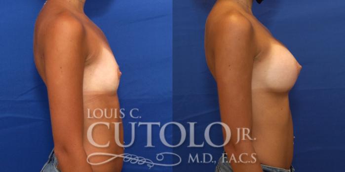 Before & After Breast Augmentation Case 231 Right Side View in Brooklyn, Staten Island, Queens, NY