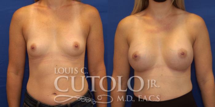 Before & After Breast Augmentation Case 232 Front View in Brooklyn, Staten Island, Queens, NY