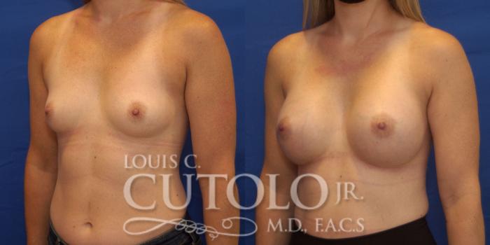 Before & After Breast Augmentation Case 232 Left Oblique View in Brooklyn, Staten Island, Queens, NY