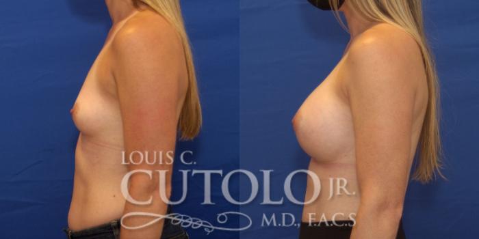 Before & After Breast Augmentation Case 232 Left Side View in Brooklyn, Staten Island, Queens, NY