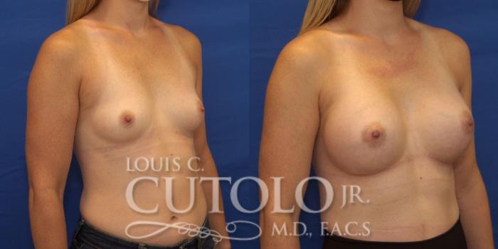 Before & After Breast Augmentation Case 232 Right Oblique View in Brooklyn, Staten Island, Queens, NY