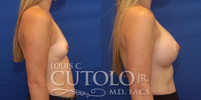 Before & After Breast Augmentation Case 232 Right Side View in Brooklyn, Staten Island, Queens, NY