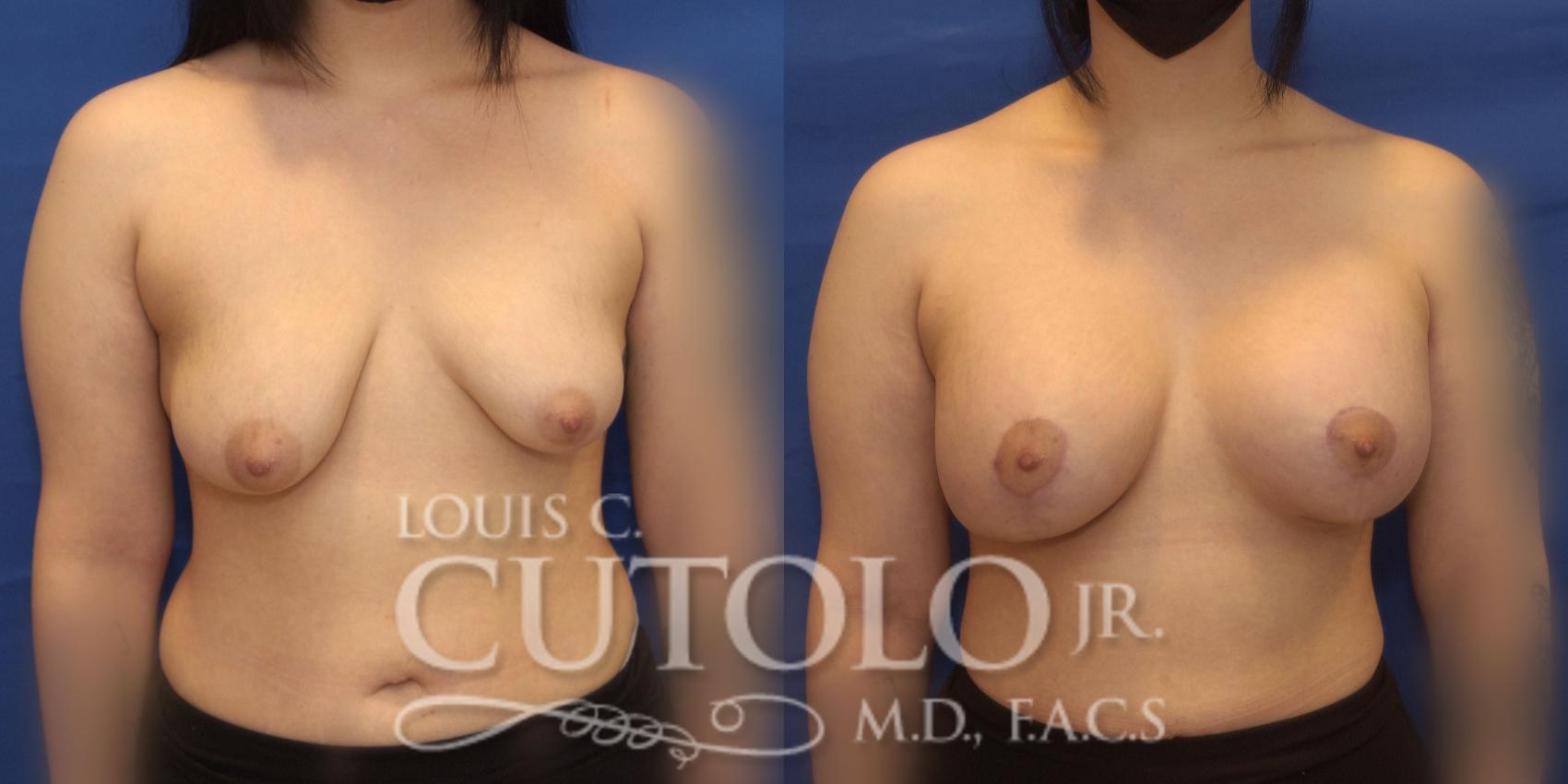 Before & After Breast Lift Case 233 Front View in Brooklyn, Staten Island, Queens, NY