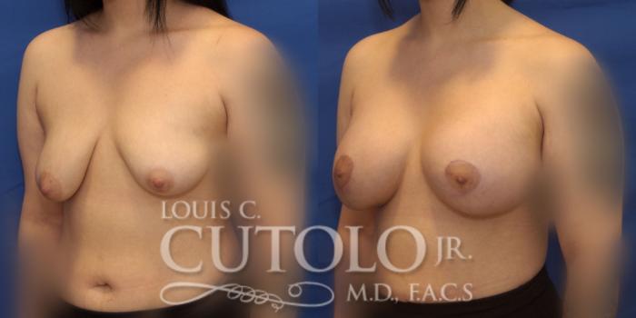 Before & After Breast Lift Case 233 Left Oblique View in Brooklyn, Staten Island, Queens, NY