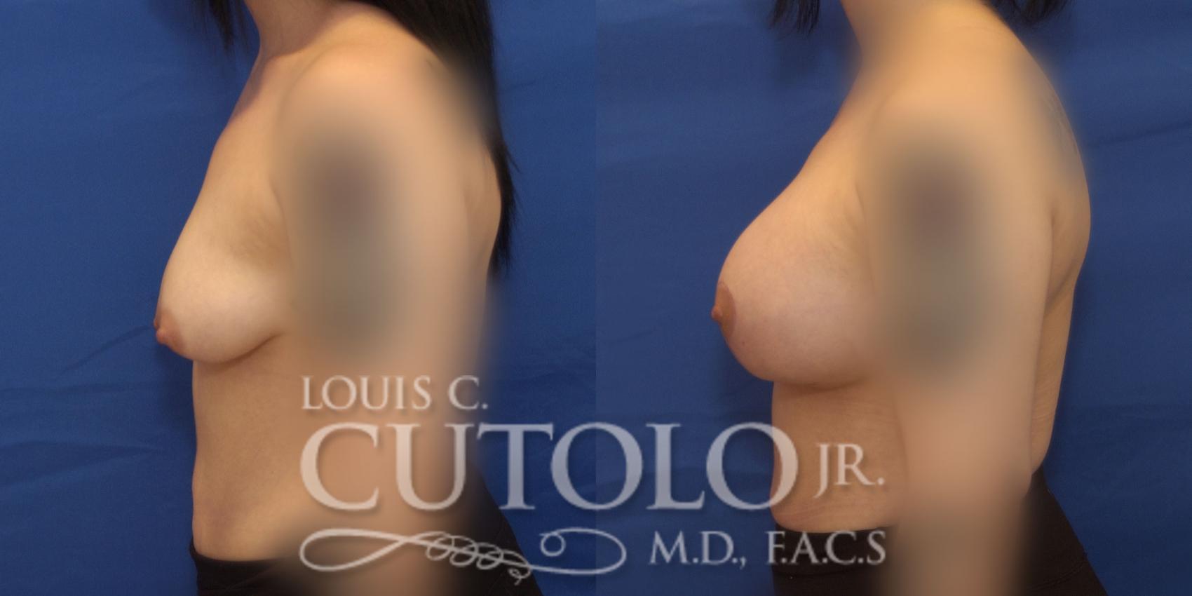 Before & After Breast Augmentation Case 233 Left Side View in Brooklyn, Staten Island, Queens, NY