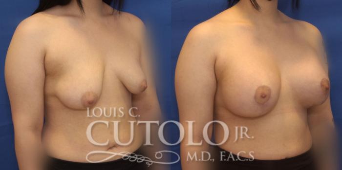 Before & After Breast Lift Case 233 Right Oblique View in Brooklyn, Staten Island, Queens, NY