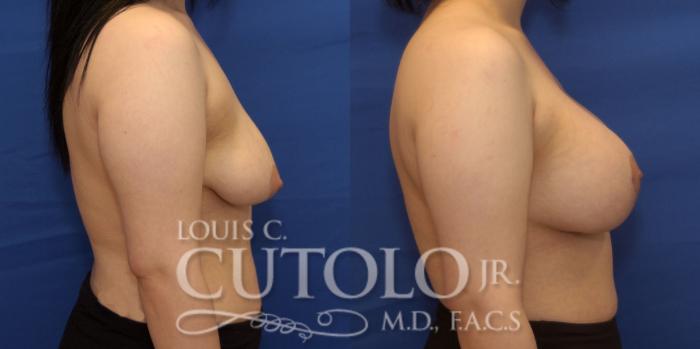 Before & After Breast Lift Case 233 Right Side View in Brooklyn, Staten Island, Queens, NY