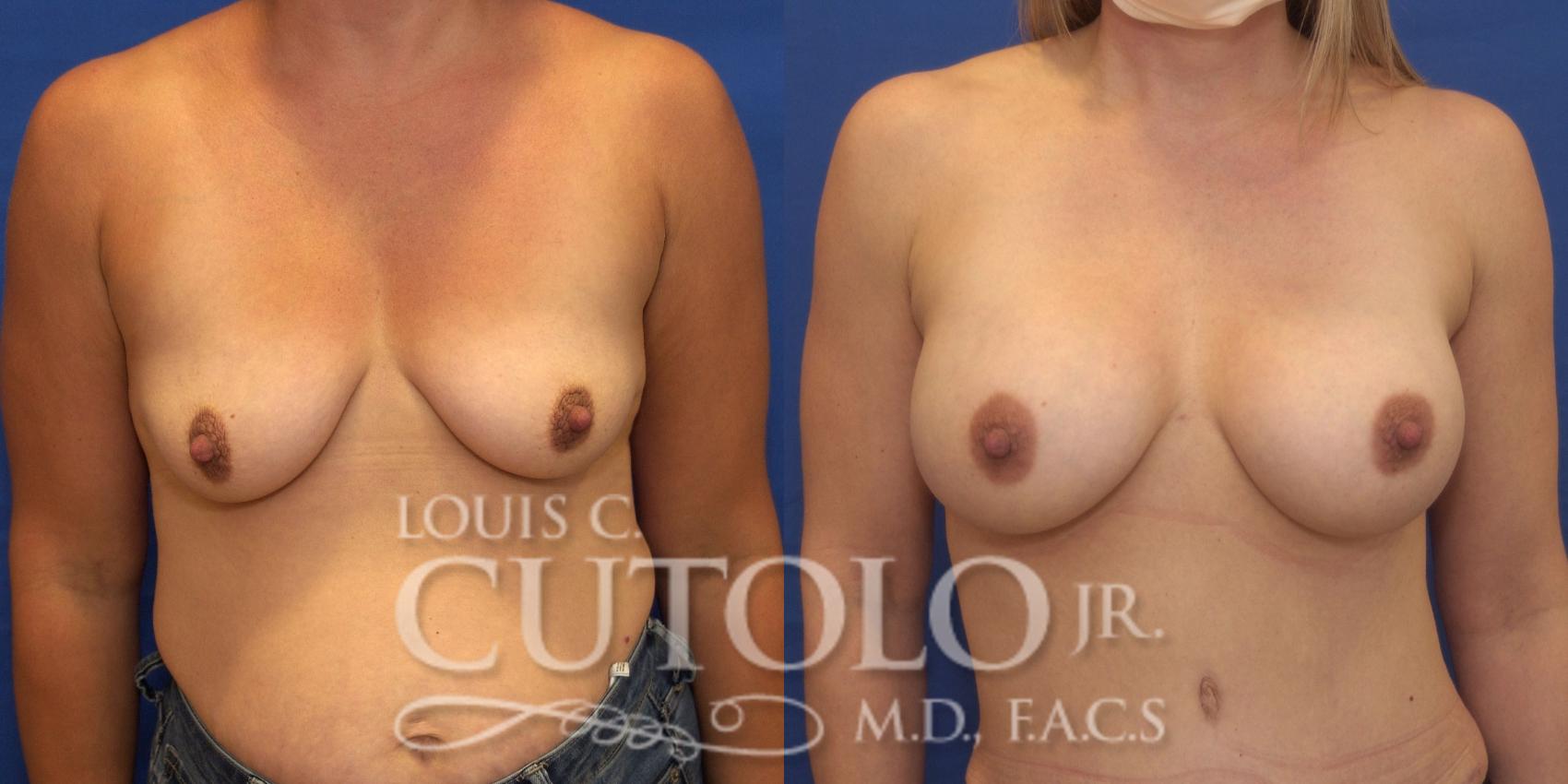 Before & After Breast Augmentation Case 237 Front View in Brooklyn, Staten Island, Queens, NY