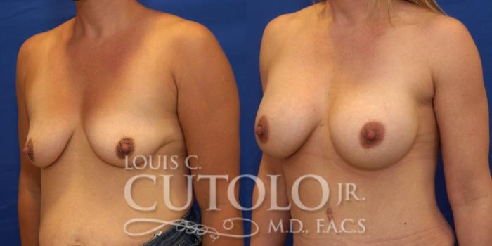 Before & After Breast Augmentation Case 237 Left Oblique View in Brooklyn, Staten Island, Queens, NY