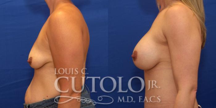Before & After Breast Augmentation Case 237 Left Side View in Brooklyn, Staten Island, Queens, NY