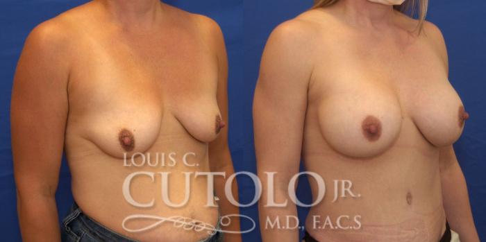 Before & After Breast Augmentation Case 237 Right Oblique View in Brooklyn, Staten Island, Queens, NY