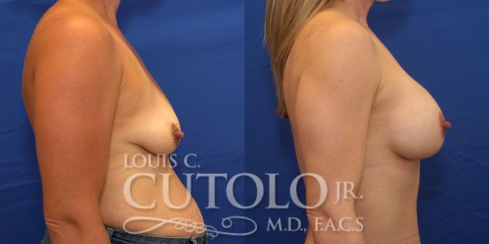 Before & After Breast Augmentation Case 237 Right Side View in Brooklyn, Staten Island, Queens, NY