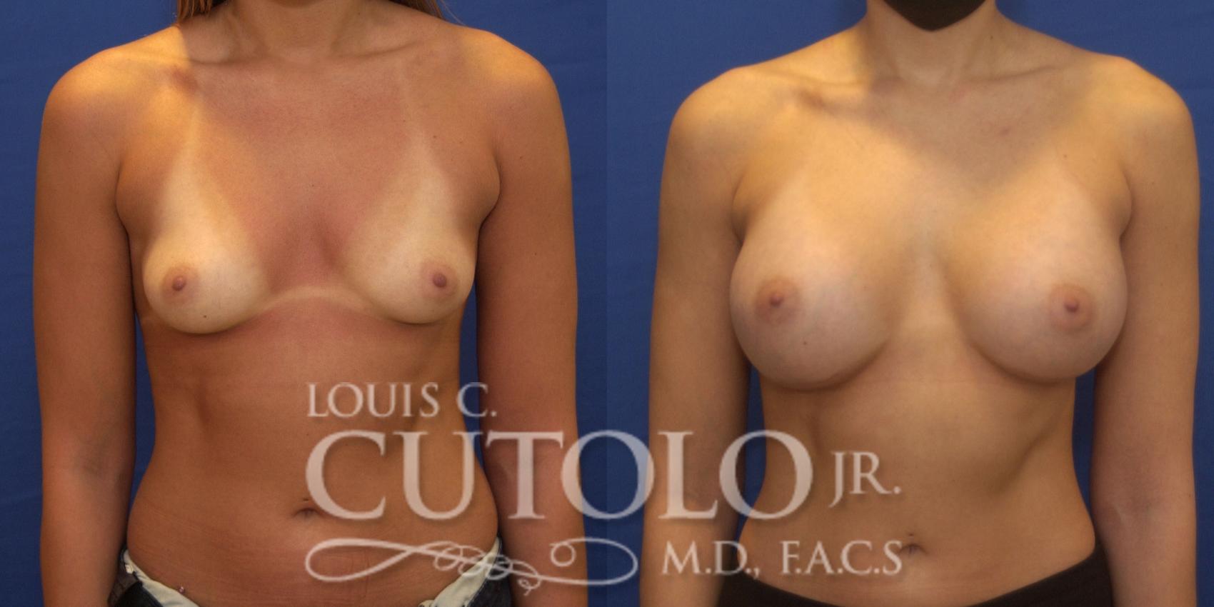 Before & After Breast Augmentation Case 239 Front View in Brooklyn, Staten Island, Queens, NY