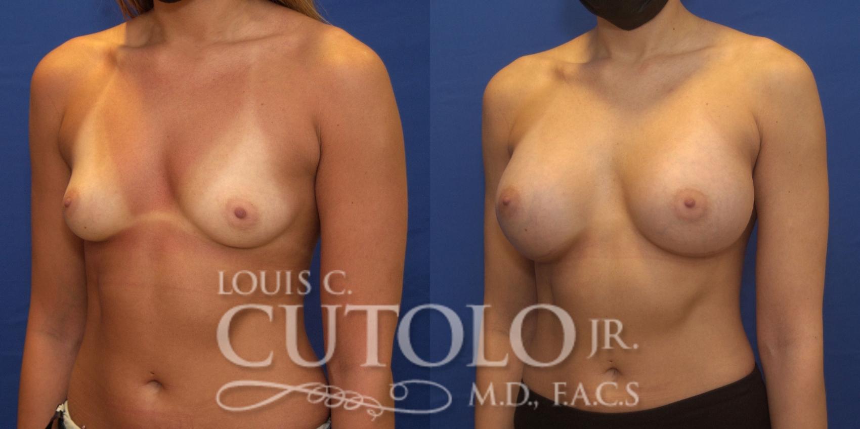 Before & After Breast Augmentation Case 239 Left Oblique View in Brooklyn, Staten Island, Queens, NY