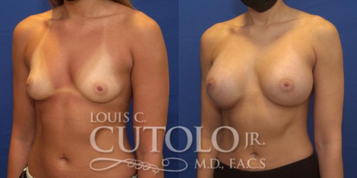Before & After Breast Augmentation Case 239 Left Oblique View in Brooklyn, Staten Island, Queens, NY