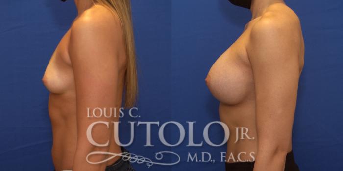 Before & After Breast Augmentation Case 239 Left Side View in Brooklyn, Staten Island, Queens, NY