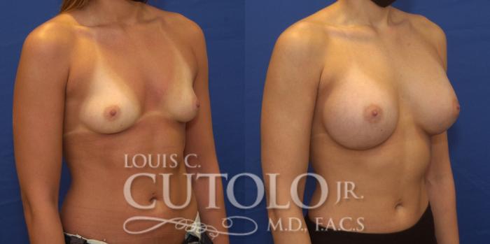 Before & After Breast Augmentation Case 239 Right Oblique View in Brooklyn, Staten Island, Queens, NY