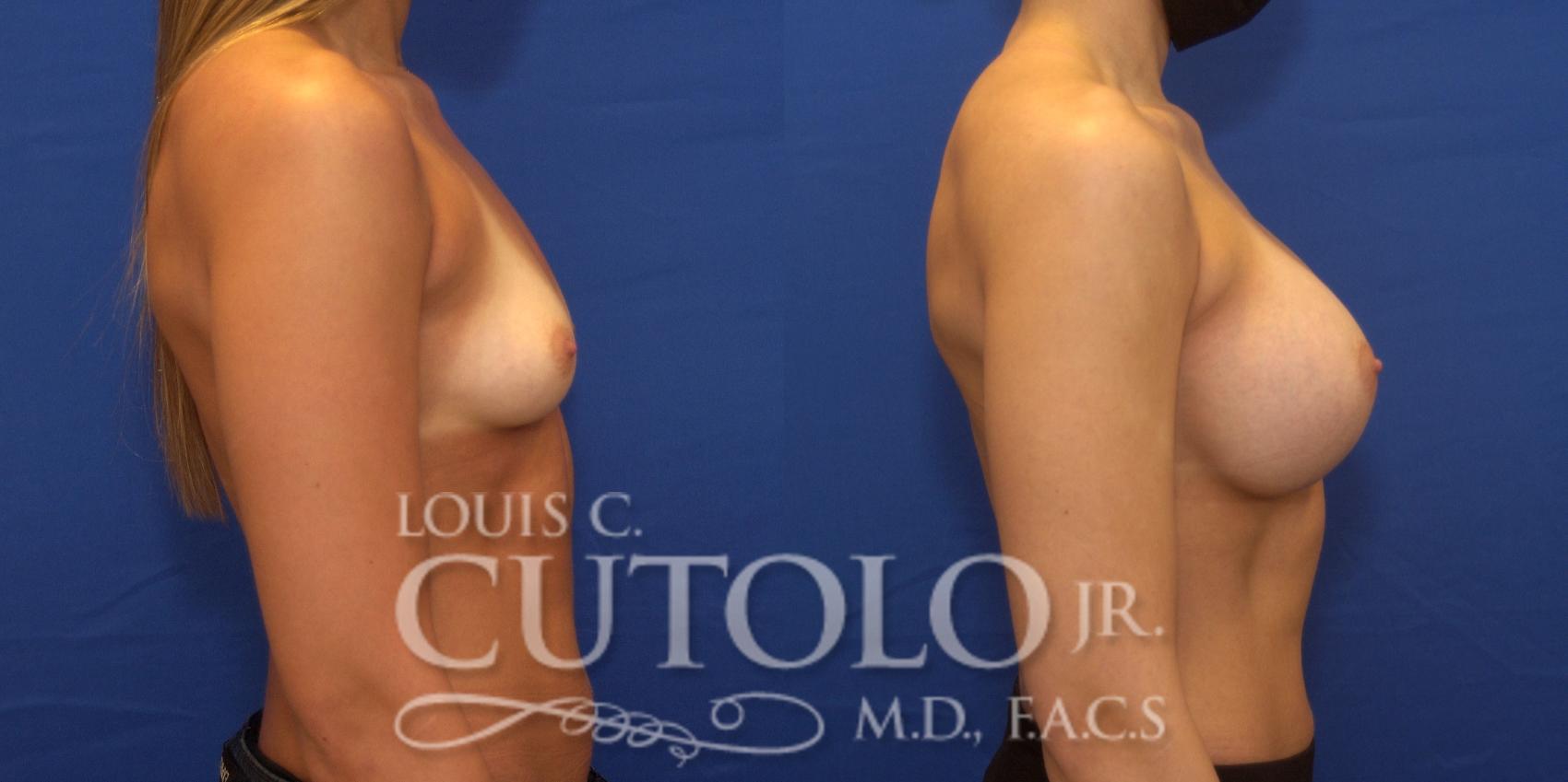 Before & After Breast Augmentation Case 239 Right Side View in Brooklyn, Staten Island, Queens, NY