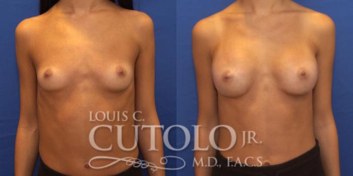 Before & After Breast Augmentation Case 240 Front View in Brooklyn, Staten Island, Queens, NY