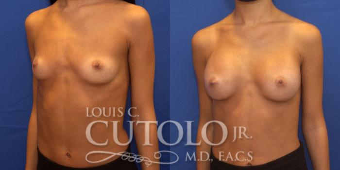 Before & After Breast Augmentation Case 240 Left Oblique View in Brooklyn, Staten Island, Queens, NY
