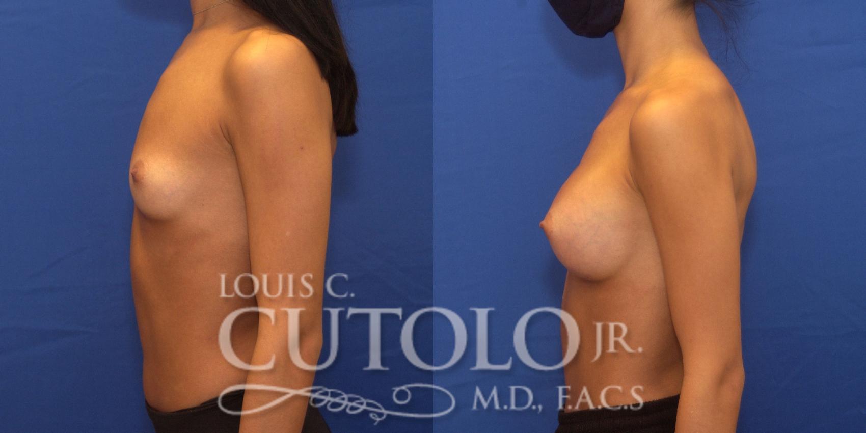 Before & After Breast Augmentation Case 240 Left Side View in Brooklyn, Staten Island, Queens, NY