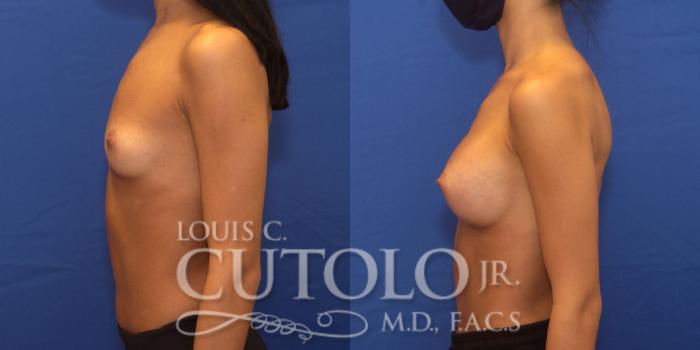 Before & After Breast Augmentation Case 240 Left Side View in Brooklyn, Staten Island, Queens, NY