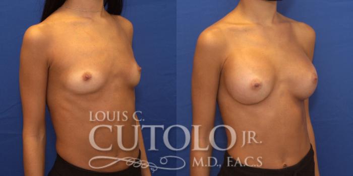 Before & After Breast Augmentation Case 240 Right Oblique View in Brooklyn, Staten Island, Queens, NY