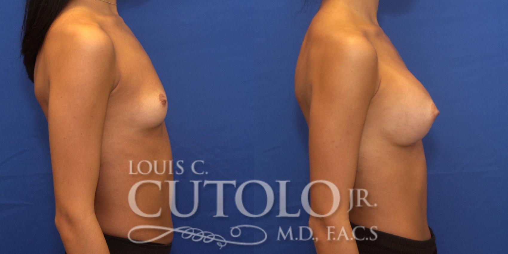 Before & After Breast Augmentation Case 240 Right Side View in Brooklyn, Staten Island, Queens, NY