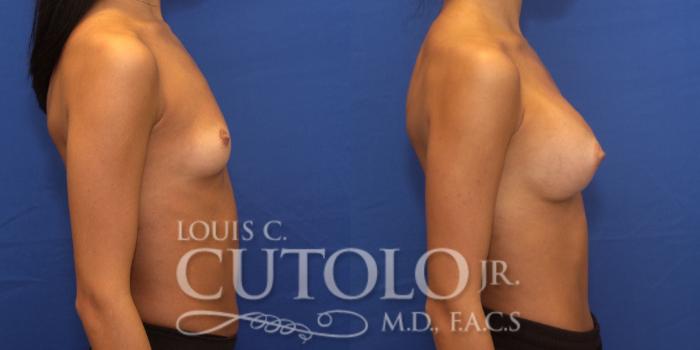 Before & After Breast Augmentation Case 240 Right Side View in Brooklyn, Staten Island, Queens, NY