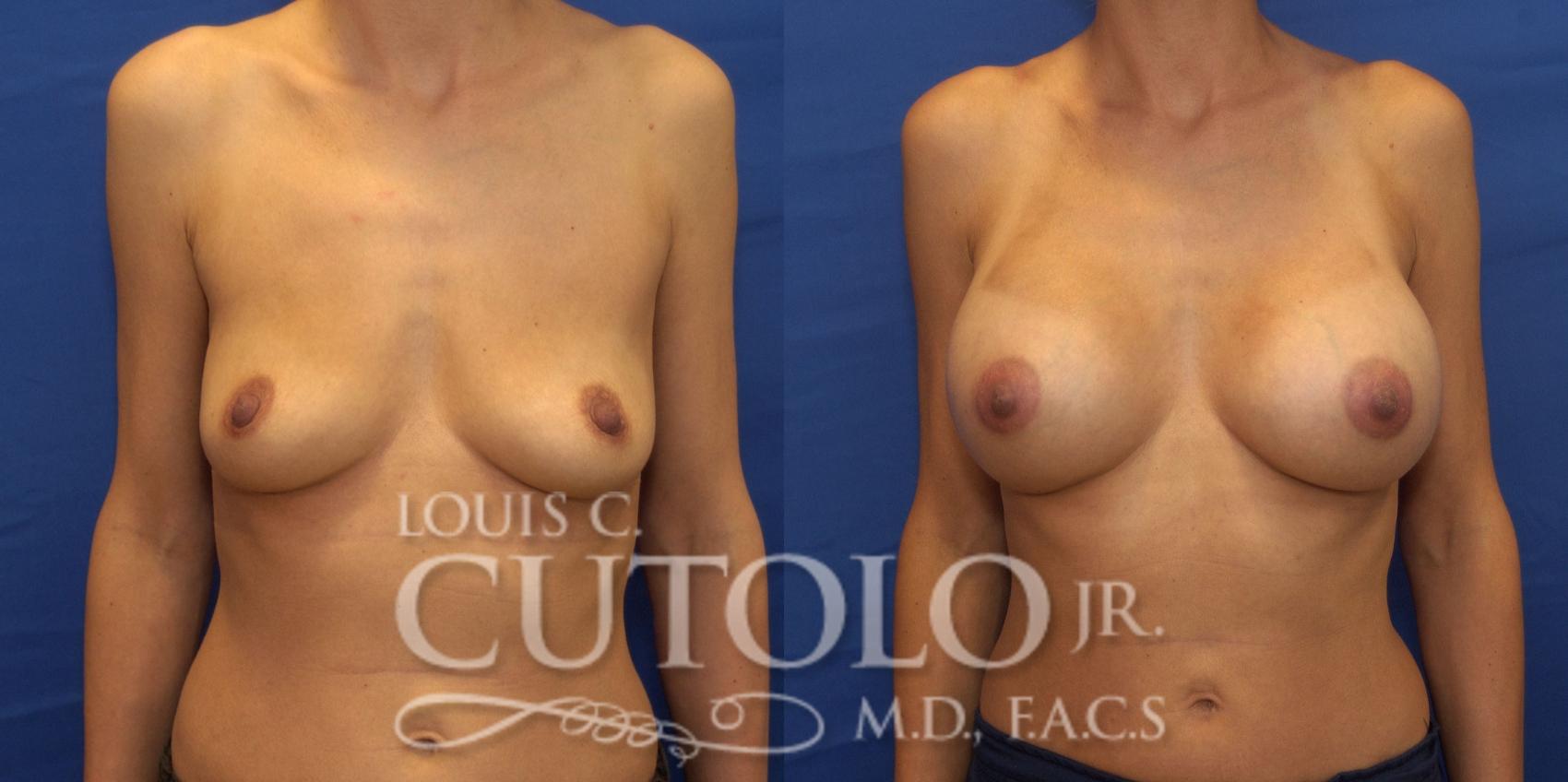 Before & After Breast Augmentation Case 241 Front View in Brooklyn, Staten Island, Queens, NY