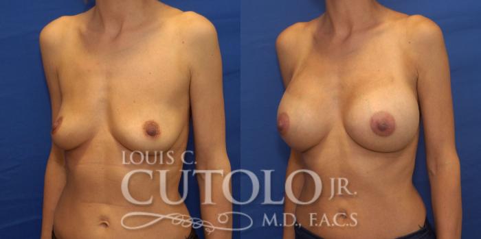 Before & After Breast Augmentation Case 241 Left Oblique View in Brooklyn, Staten Island, Queens, NY