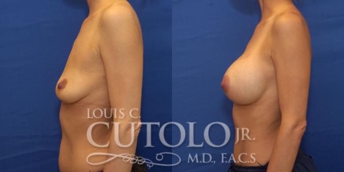 Before & After Breast Augmentation Case 241 Left Side View in Brooklyn, Staten Island, Queens, NY